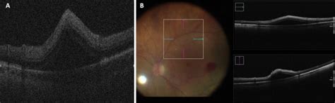 analysis  retinal alterations utilizing intraoperative oct