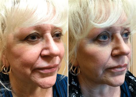 liquid botox reviews  botox   bottle jmnbc