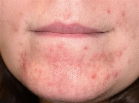 Is this fungal acne, perioral dermatitis, or something else? Please ...