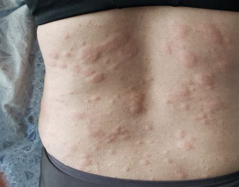 Chronic Idiopathic Urticaria (CIU) - Patient Education