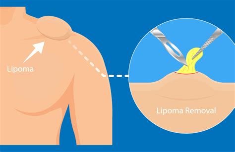Lipoma Removal | Metropolis Dermatology