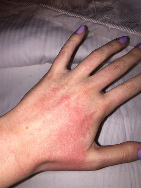 Accutane Side Effects Rash