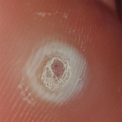 what else can I do? : r/Warts