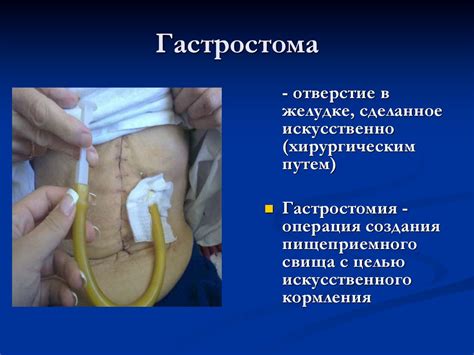 Стомы. Уход за стомированным пациентом - презентация онлайн