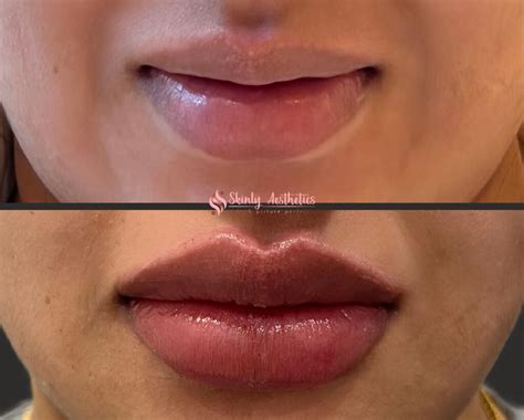 Russian Lip Filler Near Me: The Ultimate Guide To Plump, Natural ...
