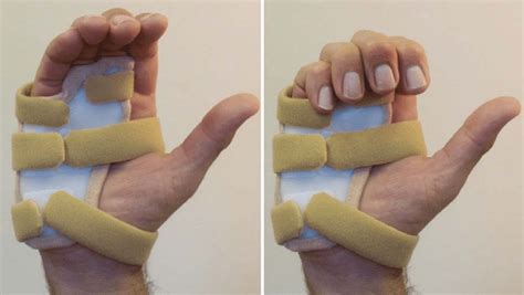 triggerintrinsic stretch splint  volar hand based splint