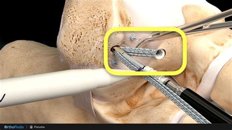 Foot and Ankle Fellowship Forum: Perfecting Your ATFL Repair ...