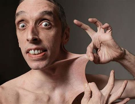 EHLERS- DANLOS SYNDROME (EDS) - MEDizzy