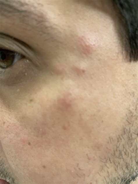 Itchy face bumps : r/DermatologyQuestions