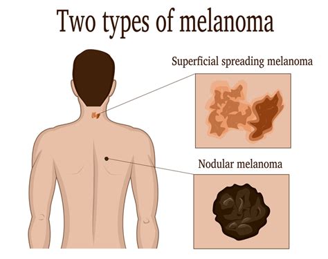 What Is Nodular Melanoma? - University Health News