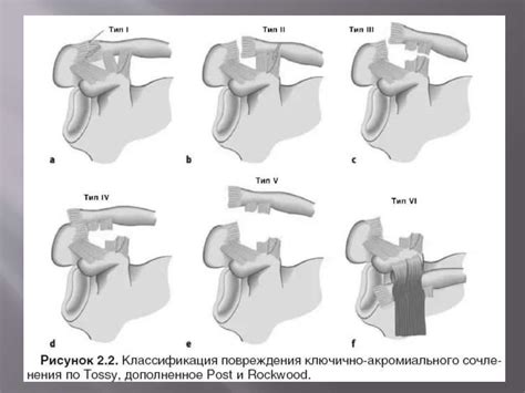 Разрыв акромиально ключичного сочленения - online presentation