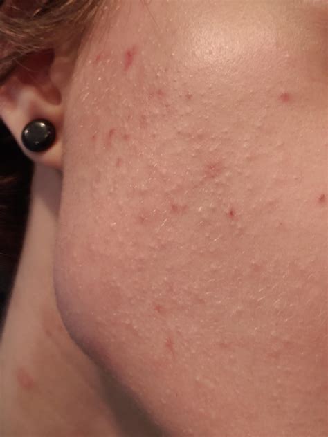 acne tons  tiny whiteheads    cheeksjaw area  idea