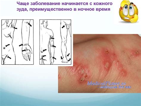 Инфекционные и паразитарные заболевания кожи - презентация онлайн