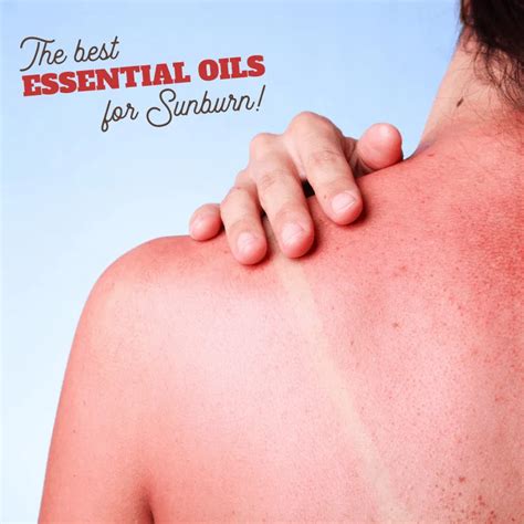 Best Essential Oils for Soothing Sunburn