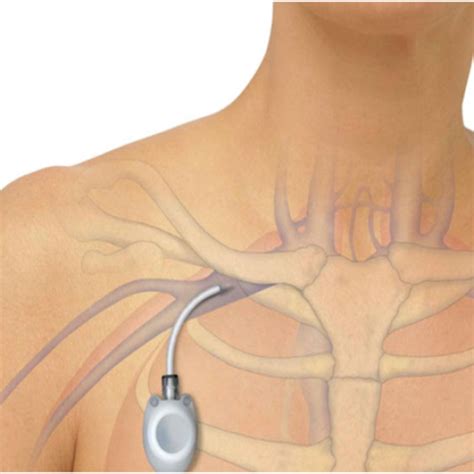 Chemo Ports: Benefits, Procedure, and Risks
