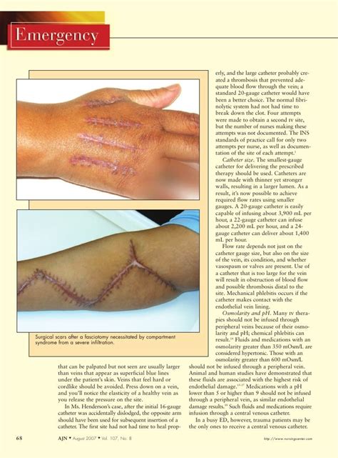 infiltration  extravasation preventing  complication  iv cathet