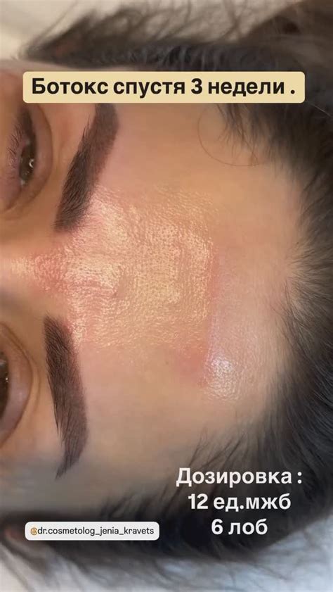 Косметолог |Ботокс | Губи| Брови ПМ| Київ| Kosmetikerin Salzburg | 💉💋 ...