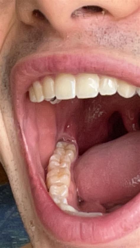 Wisdom teeth update, now fully functional! : r/orthotropics