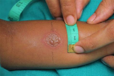 Ppd Test : Signs of a Positive TB Test | Livestrong.com : What does ppd