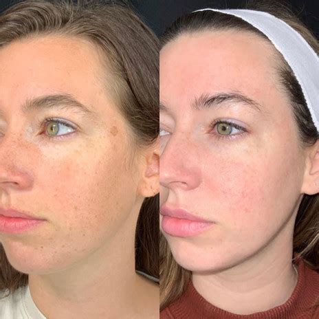 BBL Photofacial Before and After | Revee Aesthetics