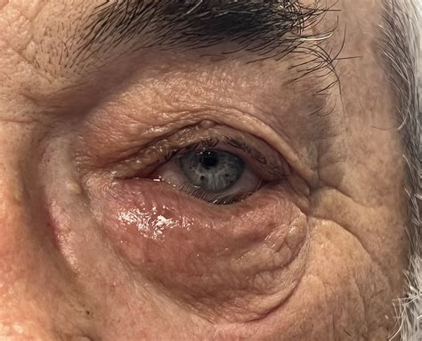 Unraveling the Mystery of Entropion: Its Causes, Signs, and Remedies
