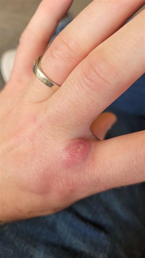 Dog Bite Hand Infection