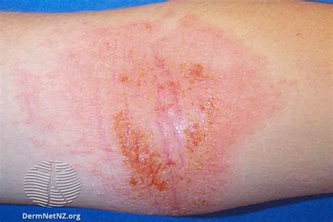 Dyshidrotic Eczema Arms