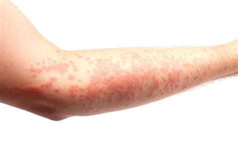 Heat Rash On Arms And Legs