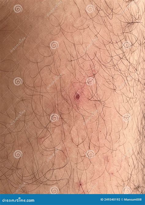 Scar on Skin. the Wound Form Scabs on Leg. Man with Long Scab Wound on