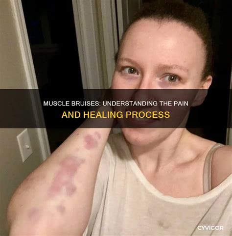 Muscle Bruises: Understanding The Pain And Healing Process | CyVigor
