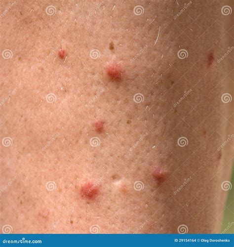 Dermatitis On Lower Leg