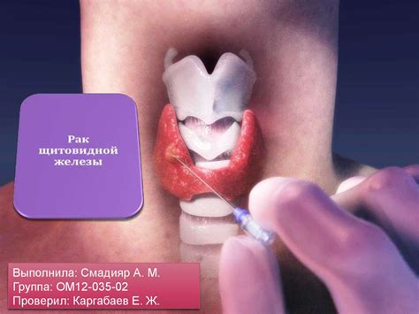 Рак щитовидной железы. Этиология. Способствующие факторы - online ...