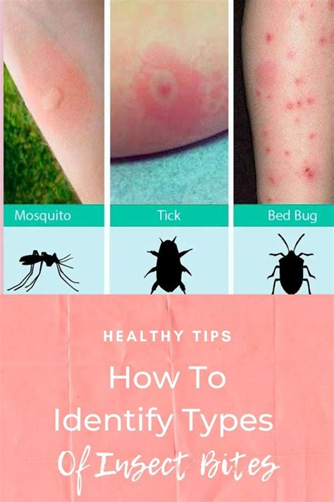 Insect Bites - How To Identify Types Of Insect Bites | Insect bites ...
