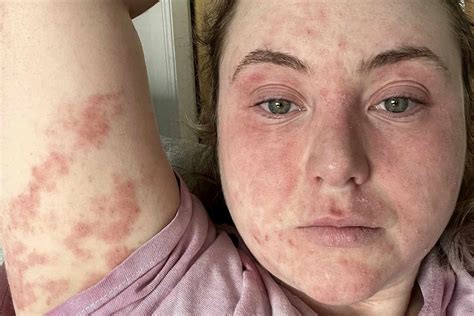 face allergic reaction  cream  samantha tomlinson blog