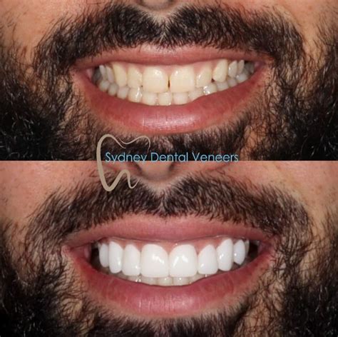 porcelain veneers sydney cost sydneydentalveneercomau