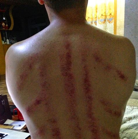 massage scraping  luca swift blog