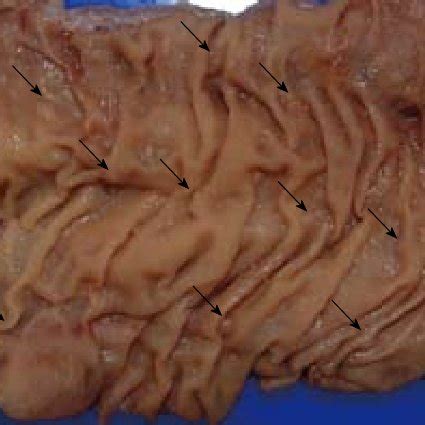 (PDF) Serrated polyposis syndrome: Molecular, pathological and clinical ...