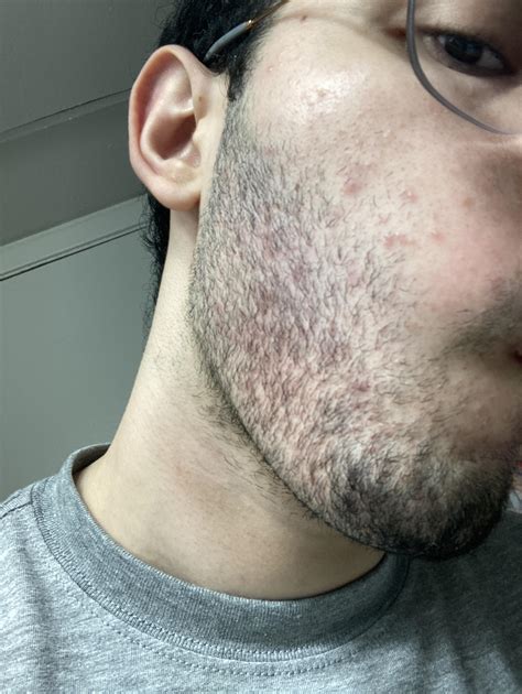 19, I’ve never had any beard problems before until about a month and a