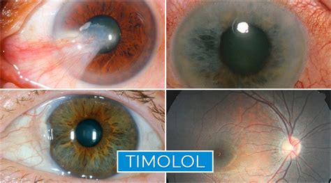 Timolol | CartPharmacy.Com