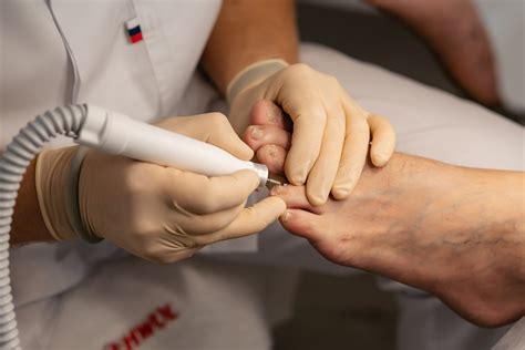 Микоз ногтей