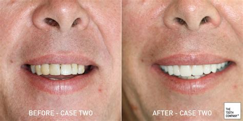 Bad Teeth | Teeth are falling apart | Smile makeover