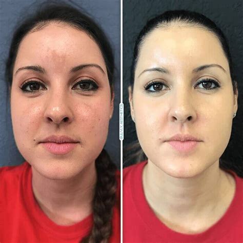 Juvly Aesthetics: IPL Photofacial Reverse Signs of Aging