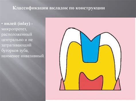 Замещение дефектов коронки зуба коронковыми вкладками - online presentation