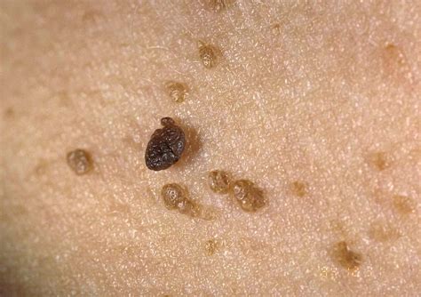 Keratosis Sales Discounts | www.pinnaxis.com