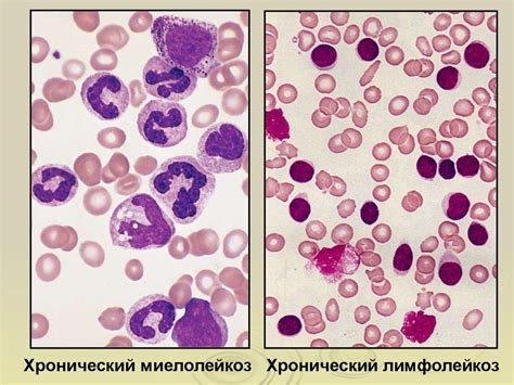 Лейкозы, лейкоцитозы, лейкопении - презентация онлайн