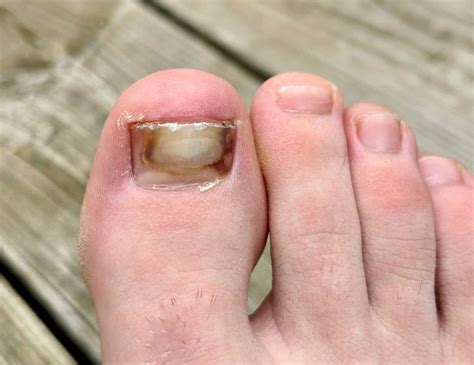 Tips For When Your Toenail Is on The Verge Of Falling Off - Feet First