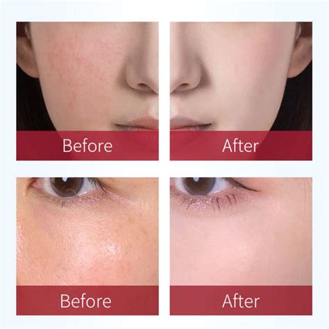 Rosaderm Fast Gel Cream 30g - Corrective Anti-Redness Treatment