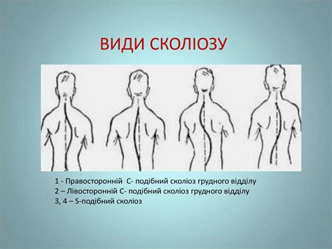 Сколіотична хвороба. Класифікація сколіотичної хвороби за етіологією ...