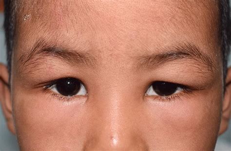 Upper Eyelid Infection
