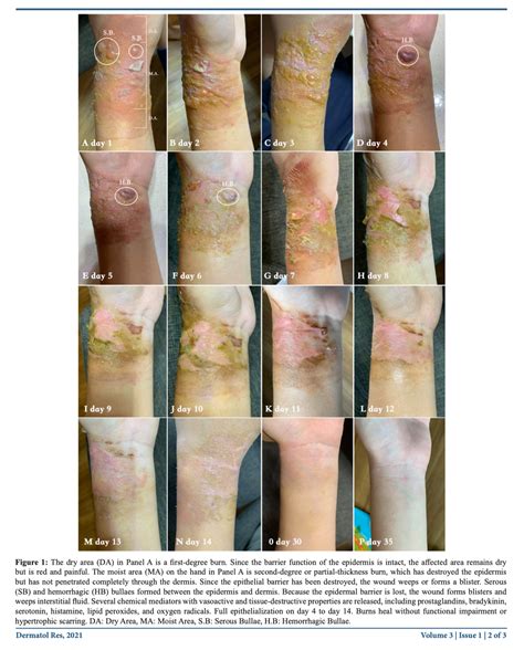 How To Cure Second Degree Burns - Theatrecouple Cafezog
